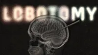 Lobotomy
